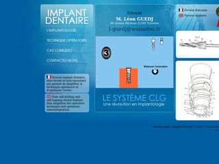 Implant dentaire avec Implantdentaireclg.com